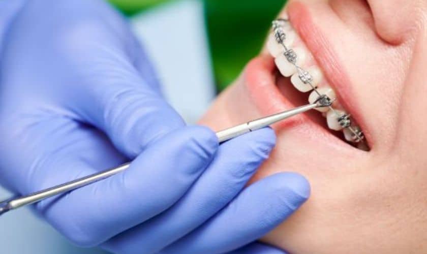 Braces for adults in Houston