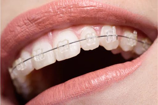 Ceramic Braces