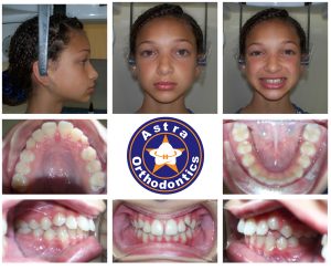 Get straight teeth Houston