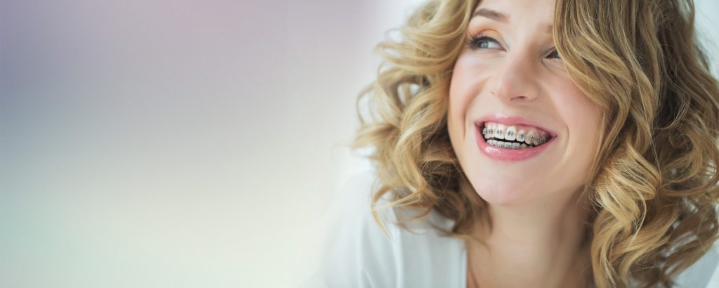 Self-ligating braces Houston