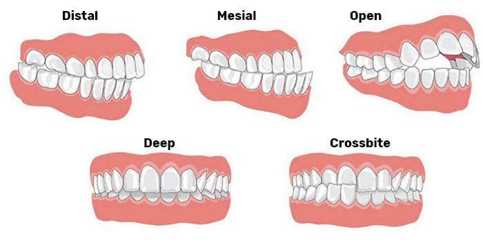 Types of Jaw & Bite Irregularities