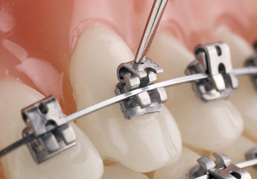 Benefits of self-ligating braces