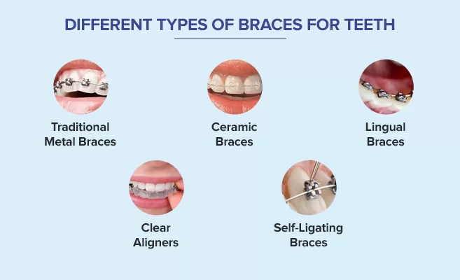 Modern braces and aligners