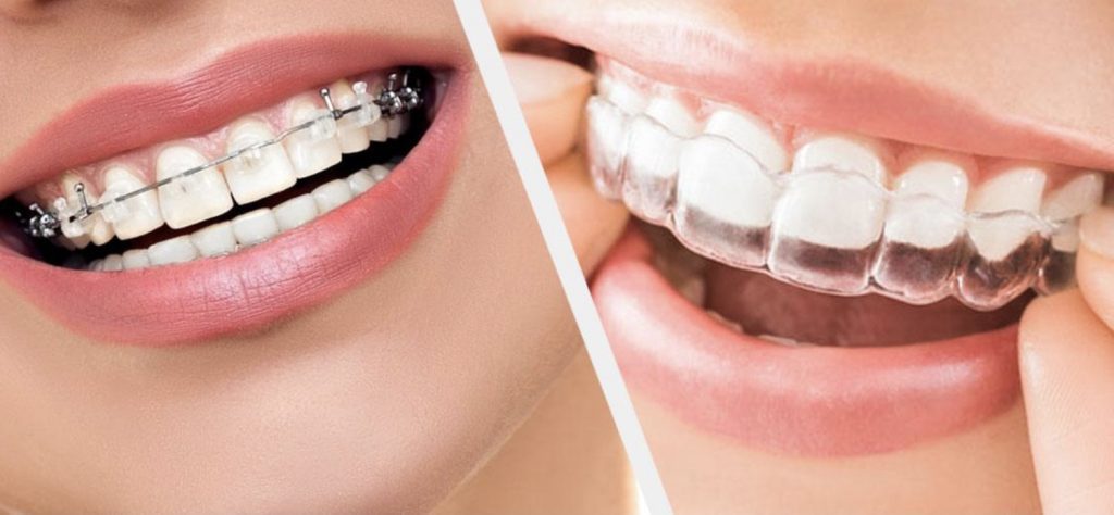 Houston Invisalign provider