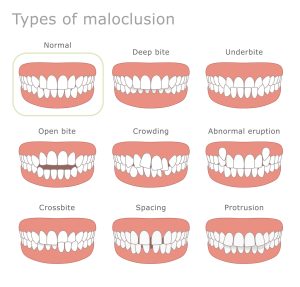 What are the common signs I might need braces? 